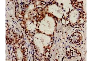 Immunocytochemistry analysis of human breast cancer using ABIN7147255 at dilution of 1:100 (RAD9A antibody  (AA 267-341))