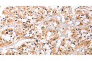 Immunohistochemistry of paraffin-embedded Human thyroid cancer using HDAC8 Polyclonal Antibody at dilution of 1:40 (HDAC8 antibody)