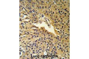 COG2 Antibody (N-term) IHC analysis in formalin fixed and paraffin embedded human Lung carcinoma followed by peroxidase conjugation of the secondary antibody and DAB staining. (COG2 antibody  (N-Term))