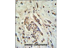 ABCC11 Antibody IHC analysis in formalin fixed and paraffin embedded breast carcinoma followed by peroxidase conjugation of the secondary antibody and DAB staining. (ABCC11 antibody  (N-Term))