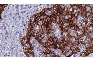 ABIN6279128 at 1/100 staining Human Head and neck cancer tissue by IHC-P. (SLC4A9 antibody)