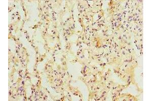 Immunohistochemistry of paraffin-embedded human lung cancer using ABIN7172386 at dilution of 1:100 (L3HYPDH antibody  (AA 13-312))