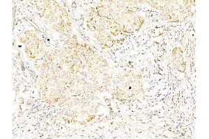 ABIN6256559 and ABIN6267439 at 1/100 staining Human breast cancer by IHC-P.