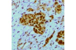 Expression of HuR in a breast tumor (FFPE section)  by staining with 19F12 monoclonal antibody (ELAVL1 antibody)