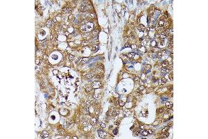 Immunohistochemistry of paraffin-embedded human colon carcinoma using MAK antibody (ABIN7268382) at dilution of 1:100 (40x lens). (MAK antibody  (AA 370-435))