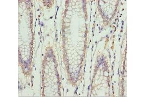 Immunohistochemistry of paraffin-embedded human colon cancer using ABIN7151997 at dilution of 1:100 (ERLIN2 antibody  (AA 212-339))
