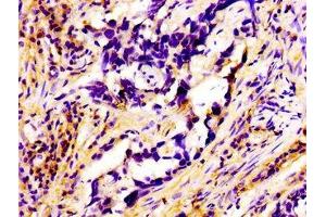 Immunohistochemistry of paraffin-embedded human pancreatic cancer using ABIN7167322 at dilution of 1:100 (RAB3A antibody  (AA 1-220))
