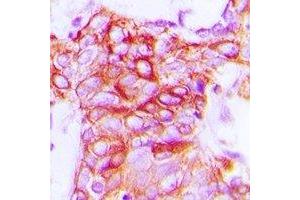 Immunohistochemical analysis of GPR101 staining in human breast cancer formalin fixed paraffin embedded tissue section. (GPR101 antibody  (C-Term))