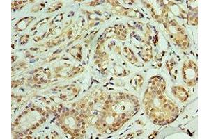 Immunohistochemistry of paraffin-embedded human breast cancer using ABIN7159904 at dilution of 1:100 (TIMM21 antibody  (AA 1-248))