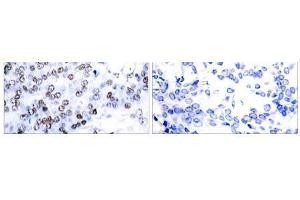 Immunohistochemical analysis of paraffin-embedded human breast carcinoma tissue using JunB (Ab-79) antibody(E021026). (JunB antibody)