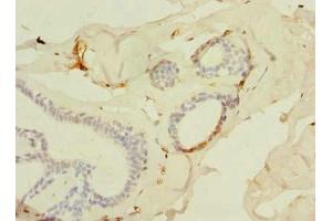 Immunohistochemistry of paraffin-embedded human breast cancer using ABIN7143534 at dilution of 1:100 (SLC25A4 antibody  (AA 40-74))