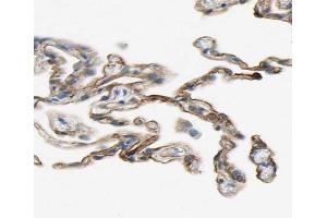 ABIN6266860 at 1/100 staining human lung carcinoma tissue sections by IHC-P.