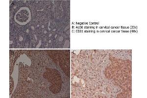 Immunohistochemistry with anti-ALG6 antibody showing ALG6 staining in the squamous epithelium of the uterine cervix as well as in inflammatory elements diffused in the stroma of human cervical cancer tissue at 20x and 40x (B & C). (ALG6 antibody  (N-Term))