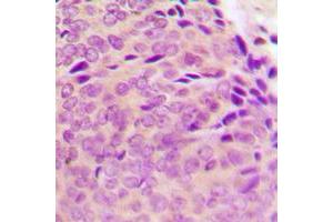 Immunohistochemical analysis of PTP1B (pS50) staining in human breast cancer formalin fixed paraffin embedded tissue section. (PTPN1 antibody  (N-Term, pSer50))