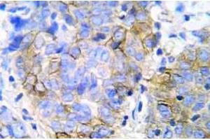 Immunohistochemistry (IHC) analyzes of JAK1 pAb in paraffin-embedded human lung adenocarcinoma tissue. (JAK1 antibody)