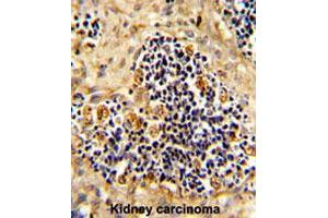 Formalin-fixed and paraffin-embedded human kidney carcionmareacted with ROR2 polyclonal antibody , which was peroxidase-conjugated to the secondary antibody, followed by AEC staining. (ROR2 antibody  (N-Term))