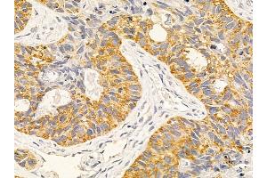 PPM1E Mouse Monoclonal Antibody at 1/100 staining human lung cancer and adjacent non-tumor tissue by IHC-P.