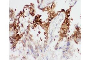IHC-P: PGK1 antibody testing of human lung cancer tissue (PGK1 antibody  (Middle Region))