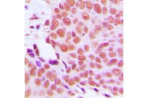 Immunohistochemical analysis of EMP staining in human breast cancer formalin fixed paraffin embedded tissue section. (MAEA antibody  (Center))