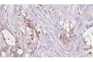 ABIN6273047 at 1/100 staining Human liver cancer tissue by IHC-P. (GSTA4 antibody  (N-Term))