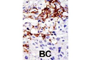 Formalin-fixed and paraffin-embedded human cancer tissue reacted with USP16 polyclonal antibody  , which was peroxidase-conjugated to the secondary antibody, followed by DAB staining .