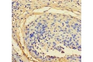 Immunohistochemistry of paraffin-embedded human cervical cancer using ABIN7176122 at dilution of 1:100 (ZNF165 antibody  (AA 1-485))