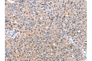 The image on the left is immunohistochemistry of paraffin-embedded Human breast cancer tissue using ABIN7128752(CAPN7 Antibody) at dilution 1/20, on the right is treated with fusion protein. (Calpain 7 antibody)
