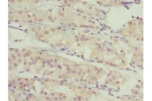 Immunohistochemistry of paraffin-embedded human gastric cancer using ABIN7166588 at dilution of 1:100 (SLC46A1 antibody  (AA 1-130))