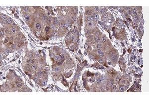 ABIN6276648 at 1/100 staining Human liver cancer tissue by IHC-P. (VAMP2 antibody  (N-Term))