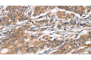 Immunohistochemistry of paraffin-embedded Human gasrtic cancer tissue using CAMK4 Polyclonal Antibody at dilution 1:40 (CAMK4 antibody)
