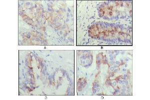 Immunohistochemical analysis of paraffin-embedded human lung cancer (A), recturn(B), prostate (C), colon cancer (D) showing cytoplasmic localization using IGFBP2 antibody with DAB staining.