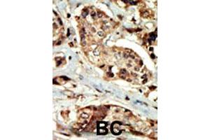 Formalin-fixed and paraffin-embedded human cancer tissue reacted with STK16 polyclonal antibody  , which was peroxidase-conjugated to the secondary antibody, followed by DAB staining. (STK16 antibody  (AA 257-286))