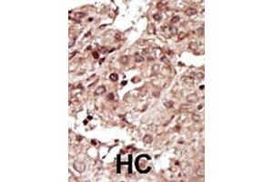 Formalin-fixed and paraffin-embedded human cancer tissue reacted with the primary antibody, which was peroxidase-conjugated to the secondary antibody, followed by AEC staining. (PHKG1 antibody  (AA 302-332))