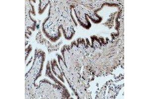 Immunohistochemical analysis of CD16 staining in human lung cancer formalin fixed paraffin embedded tissue section. (CD16 antibody)