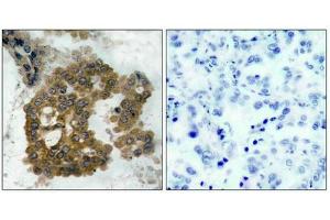 Immunohistochemical analysis of paraffin-embedded human lung carcinoma tissue using Akt2(Phospho-Ser474) Antibody(left) or the same antibody preincubated with blocking peptide(right). (AKT2 antibody  (pSer474))