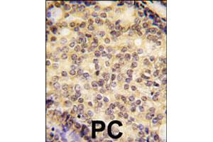 Formalin-fixed and paraffin-embedded human prostate carcinoma tissue reacted with SOX9 polyclonal antibody  , which was peroxidase-conjugated to the secondary antibody, followed by DAB staining. (SOX9 antibody  (N-Term))
