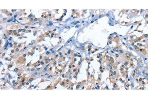 Immunohistochemistry of paraffin-embedded Human thyroid cancer tissue using PAK6 Polyclonal Antibody at dilution 1:40 (PAK6 antibody)