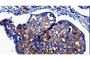 Immunohistochemistry of paraffin-embedded Human breast cancer tissue using IL10RB Polyclonal Antibody at dilution 1:60 (IL10RB antibody)