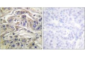 Immunohistochemistry analysis of paraffin-embedded human breast carcinoma, using RapGEF1 (Ab-504) Antibody.