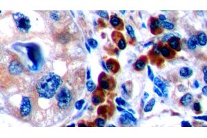 Detection of CTLA4 in Human Lymphoma Tissue using Polyclonal Antibody to Cytotoxic T-Lymphocyte Associated Antigen 4 (CTLA4) (CTLA4 antibody  (AA 52-211))