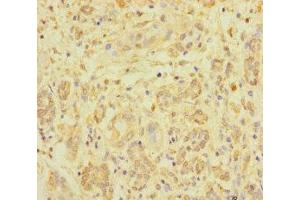 Immunohistochemistry of paraffin-embedded human pancreatic cancer using ABIN7176219 at dilution of 1:100 (ZNF287 antibody  (AA 130-364))