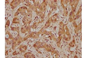 IHC image of ABIN7155266 diluted at 1:300 and staining in paraffin-embedded human melanoma cancer performed on a Leica BondTM system. (KAT2A antibody  (AA 302-537))