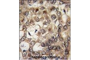 Formalin-fixed and paraffin-embedded human hepatocarcinoma tissue reacted with HIPK2 Antibody (Center) (ABIN391777 and ABIN2841636) , which was peroxidase-conjugated to the secondary antibody, followed by DAB staining. (HIPK2 antibody  (AA 437-468))