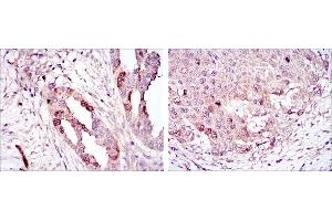Immunohistochemical analysis of paraffin-embedded ovarian cancer (left) and lung cancer (right) using AURKA mouse mAb with DAB staining. (Aurora A antibody)