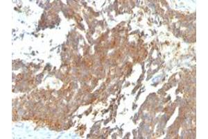 Immunohistochemical staining (Formalin-fixed paraffin-embedded sections) of human ovarian carcinoma with GNRHR/LHCGR monoclonal antibody, clone GNRHR/768 . (GNRHR antibody)