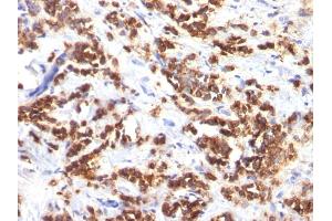 Formalin-fixed, paraffin-embedded human Breast Carcinoma stained with Milk Fat Globule Monoclonal Antibody (MFG-06) (MFGE8 antibody)