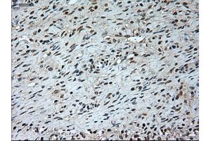 Immunohistochemical staining of paraffin-embedded Adenocarcinoma of breast tissue using anti-GAD1 mouse monoclonal antibody. (GAD antibody)