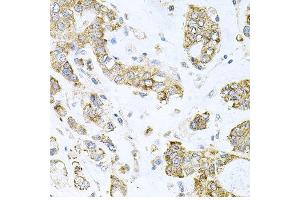Immunohistochemistry of paraffin-embedded human gastric cancer using ALKBH8 antibody at dilution of 1:100 (x40 lens). (ALKBH8 antibody)