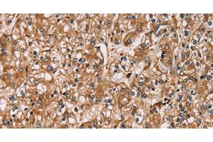 Immunohistochemistry of paraffin-embedded Human prostate cancer using HTR3C Polyclonal Antibody at dilution of 1:30 (HTR3C antibody)