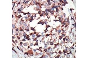 IHC analysis of FFPE human breast carcinoma tissue stained with the PKC beta antibody (PKC beta antibody  (AA 303-334))